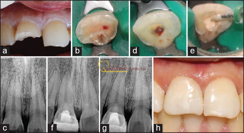 Biodentine điều trị thủng chóp
