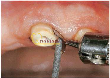 Bộ chặn nướu ZEKRYA Gingival Protector