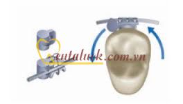 Cục chêm chỉnh lệch răng