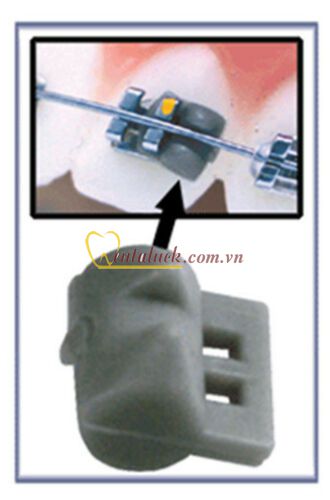 Cục chêm chỉnh lệch răng