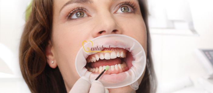Banh môi Optragate dùng một lần