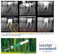 Apexit Plus – Xi măng trám bít ống tủy