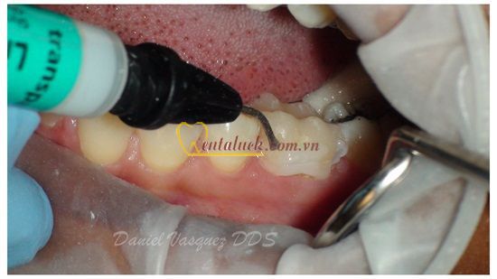 Liquid strip (Glycerin)