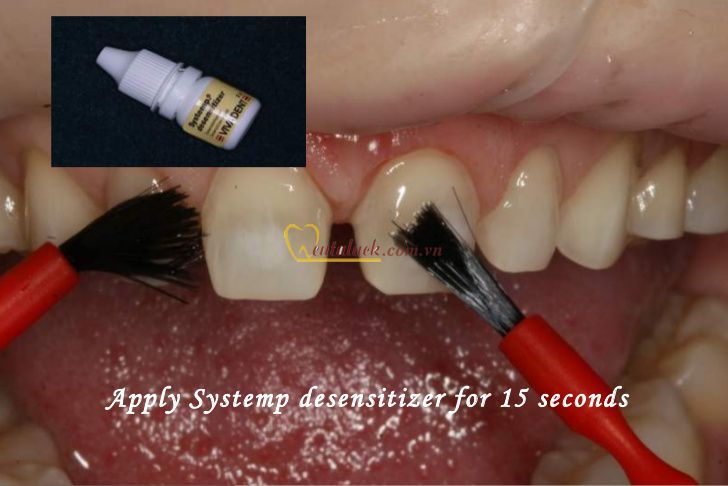 Chống ê buốt Systemp Desensitizer 5g