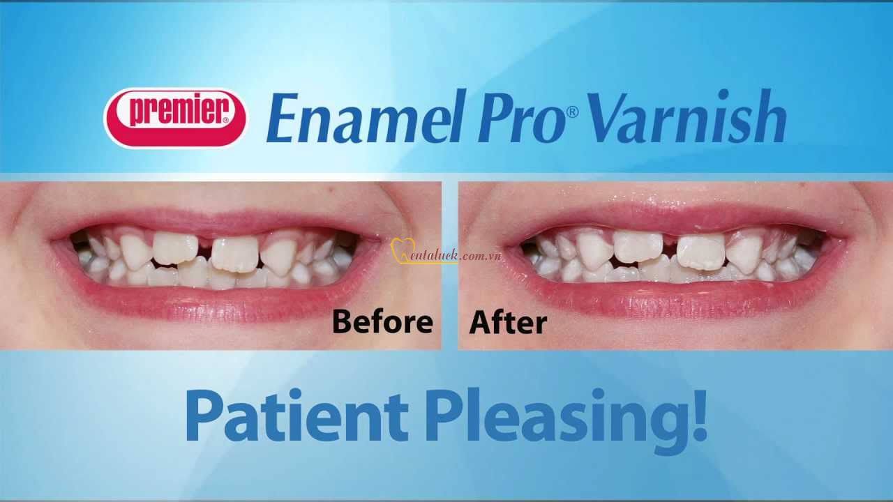 Ngừa sâu răng Enamel Pro Varnish