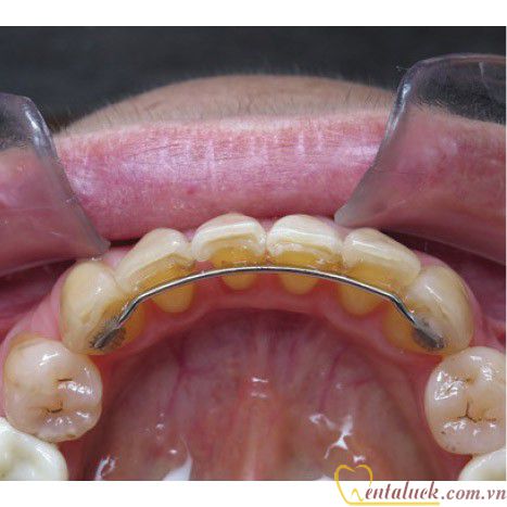 Dây bện cố định mặt lưỡi Lingual Retainer