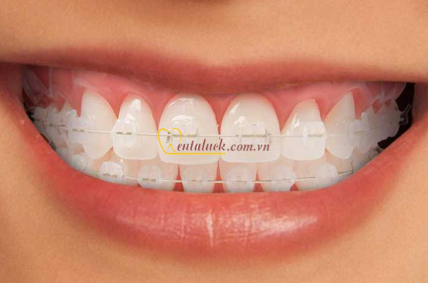 Mắc cài Sapphire RADIANCE AO (20cái/bộ)