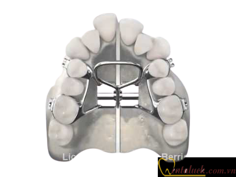 Ốc nong hàm cố định Palatal Expander RPE